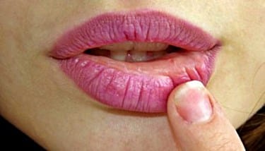 How to Reduce Cold Sore Inflammation Fast