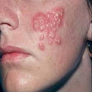 Cold Sore on the Cheek