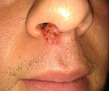 How to Treat Cold Sores Under Nose From Blowing Nose