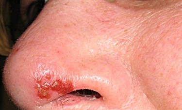cold sore under nose from blowing nose