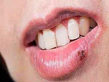 Do Cold Sores Leave Scars? 10 Things I Wish I’d Known Earlier