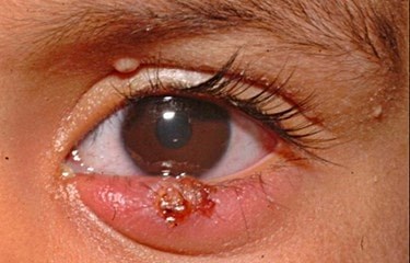 Understanding Herpes Simplex Keratitis Causes & Treatment Options