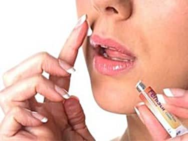 How to Stop a Cold Sore (Before It Starts)