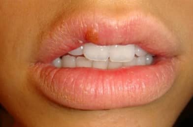 Why Do I Keep Getting Cold Sores in the Same Spot Every Time?