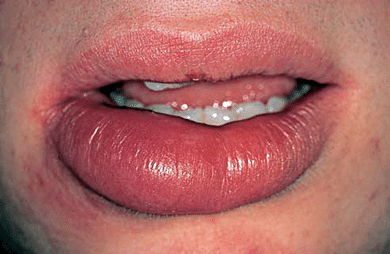 How to Reduce Cold Sore Swelling & Pain at Home Fast