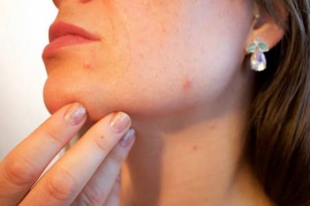 Can Birth Control Cause Cold Sores